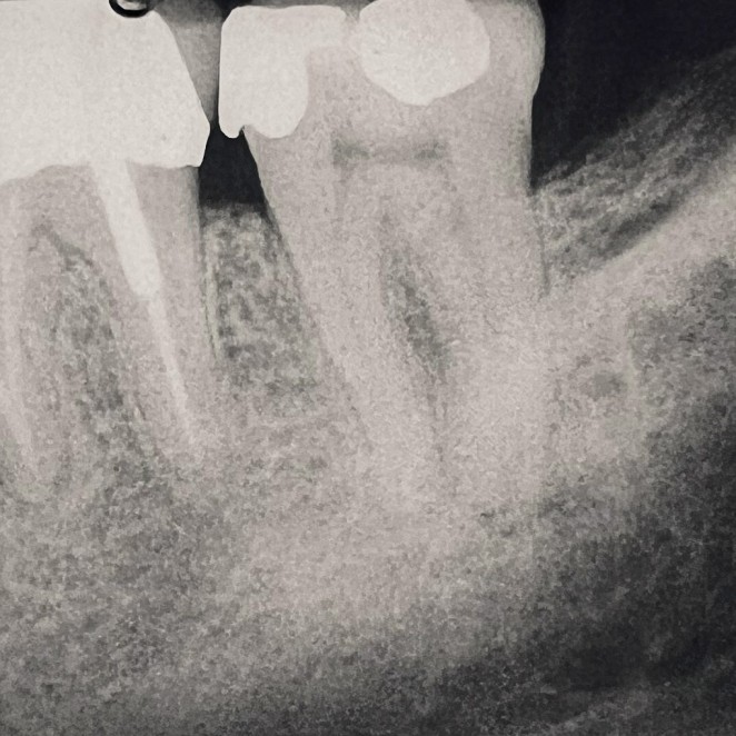 Before Endodontic Treatment Case 5 - Harp Endodontics Manhattan New York